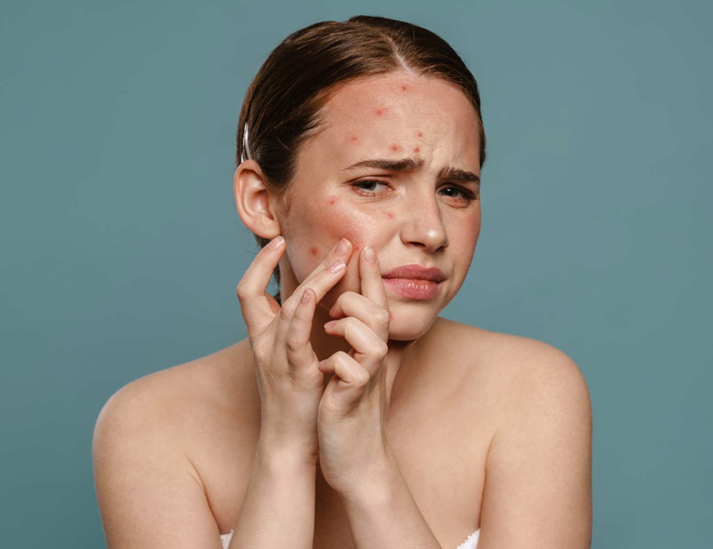 Hormonal Acne: Understanding the Link Between Hormones and Breakouts